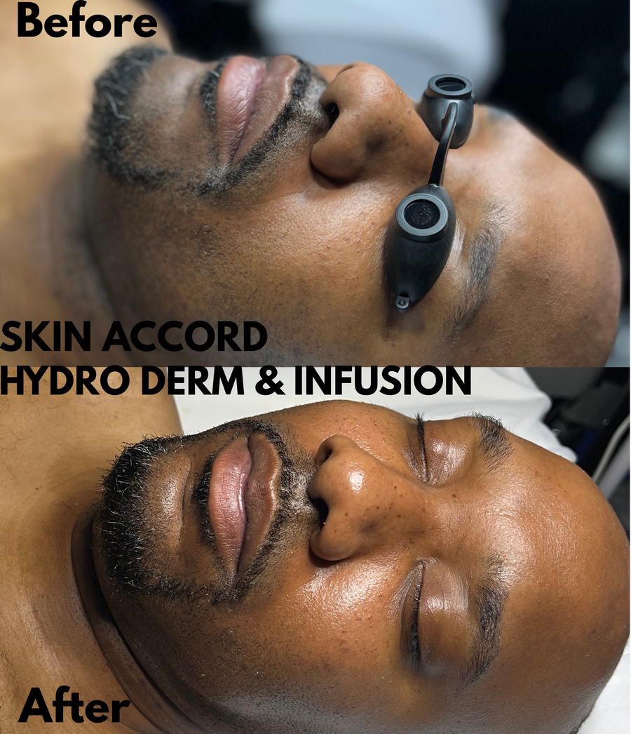 HydroFuse Facial